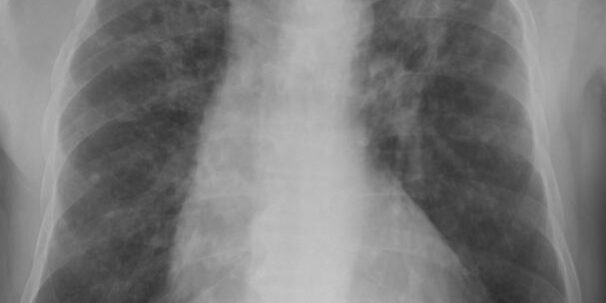 silicosis scan